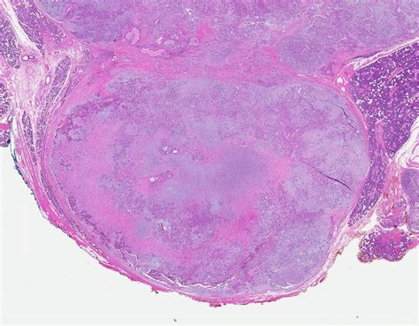 adenomul pleomorf al metaplaziei oncocitice provoacă